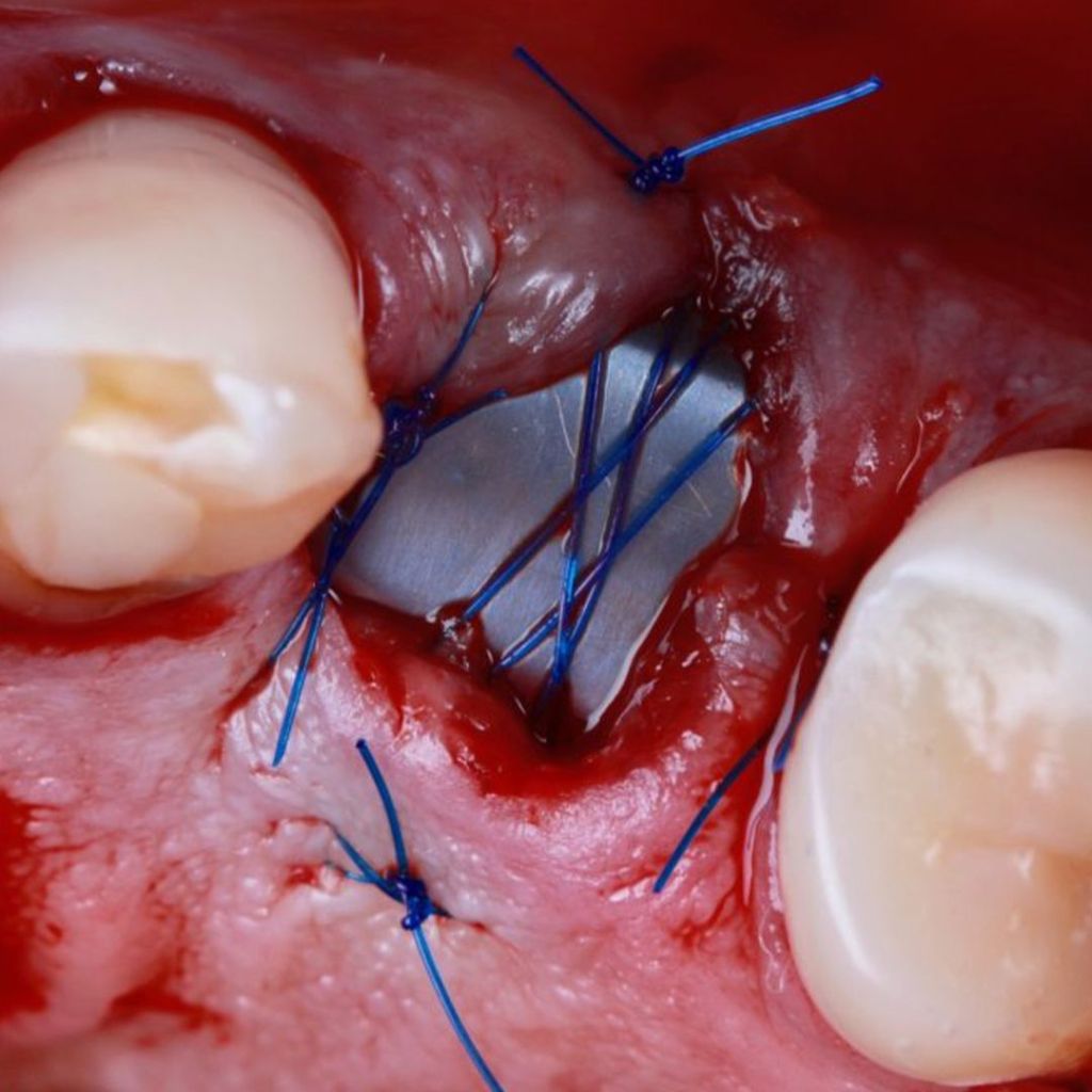 Surgitime Seal 1