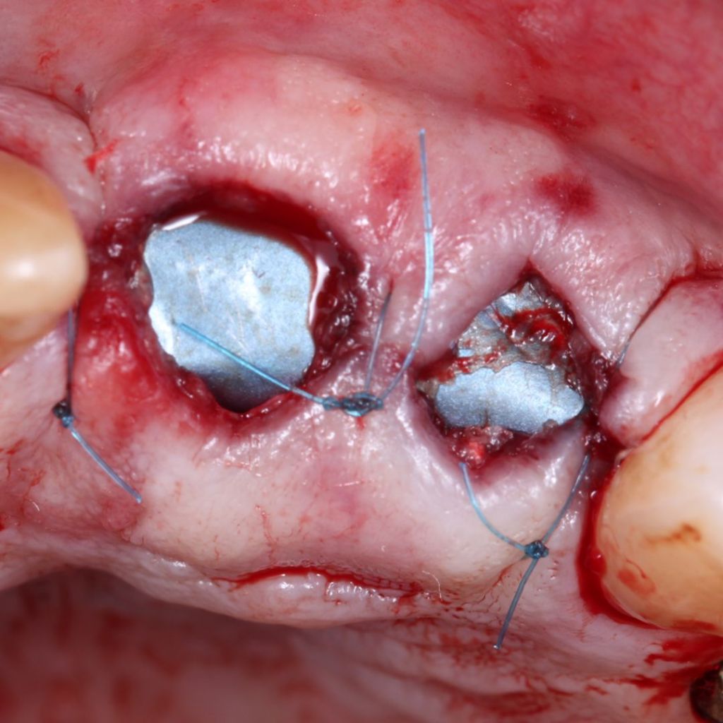 Surgitime Seal 2